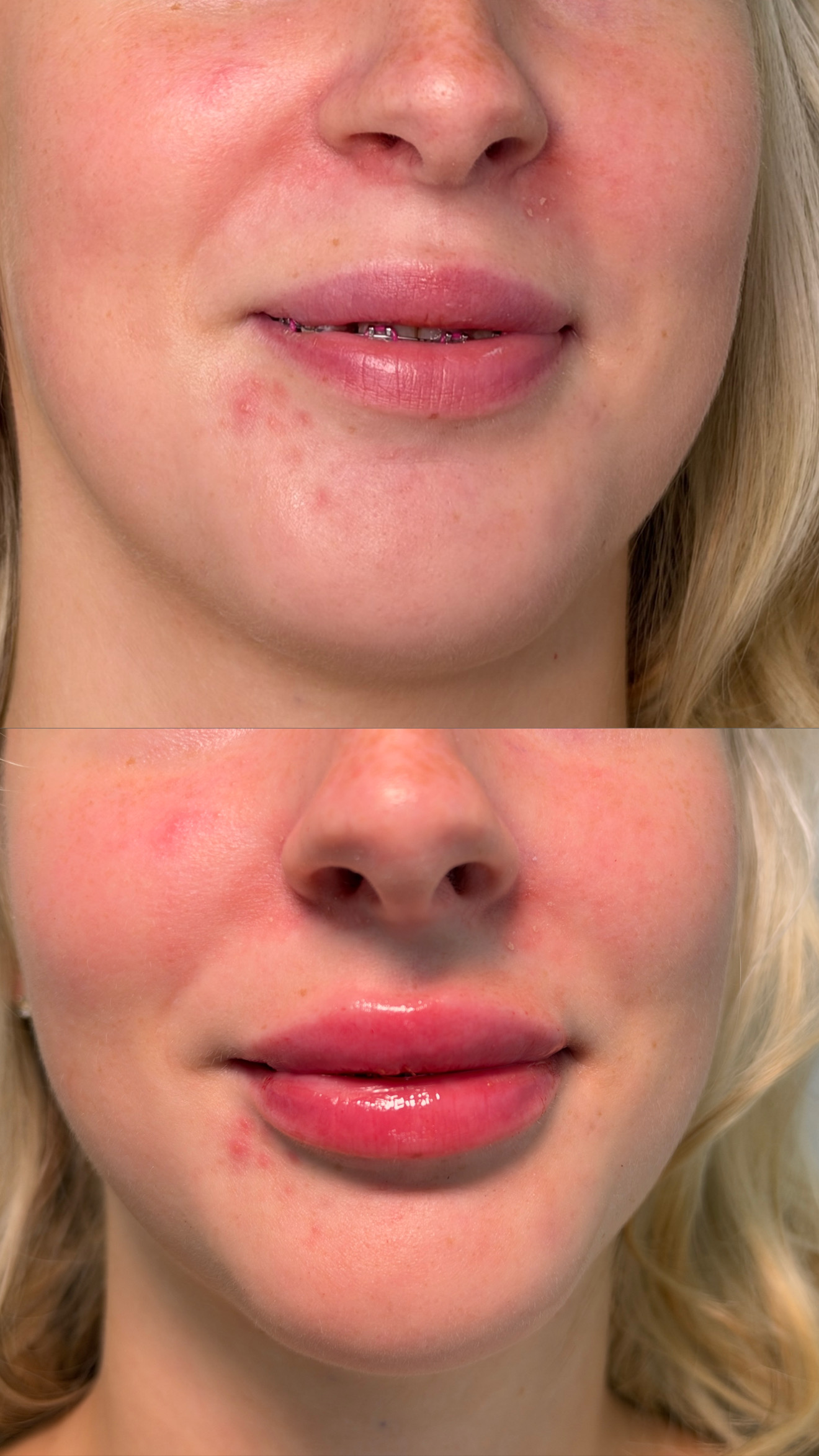 Front-view comparison supplied for a 0.5ml classic lip filler top-up