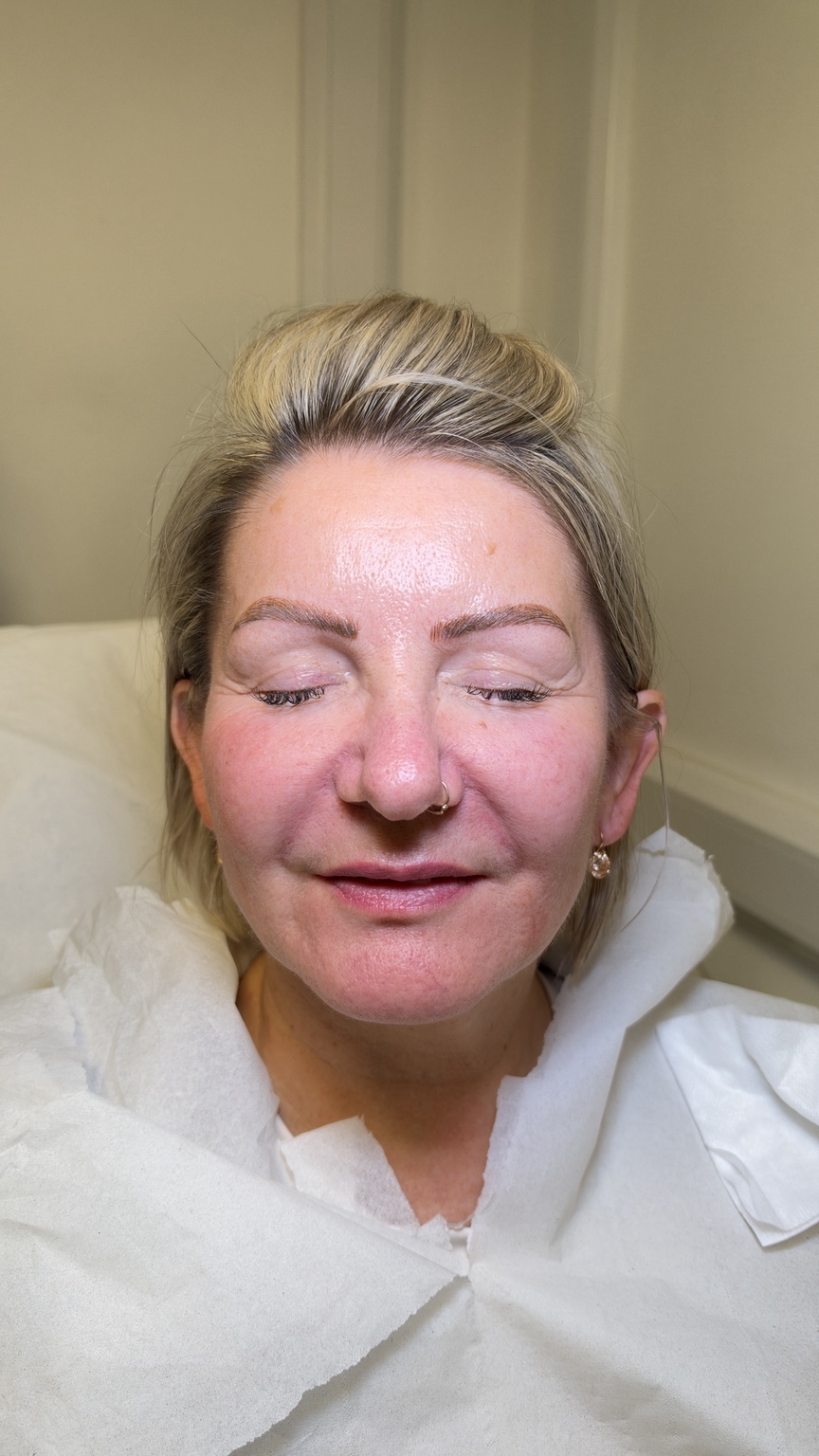 After nasolabial fold treatment, supplied by Amina